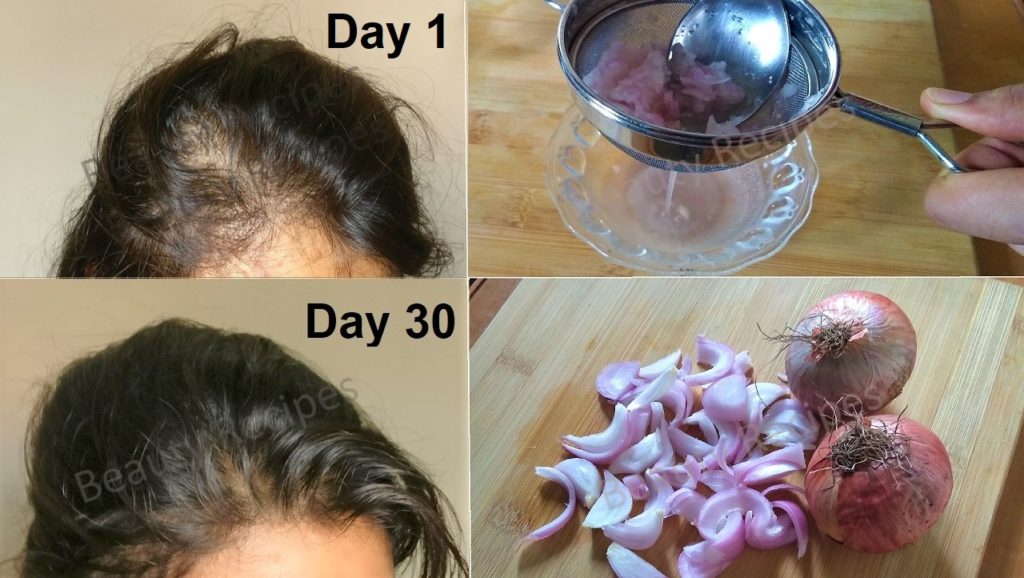 Onion juice & Onion Hair Oil for Hair Growth - Onion Benefits for Hair