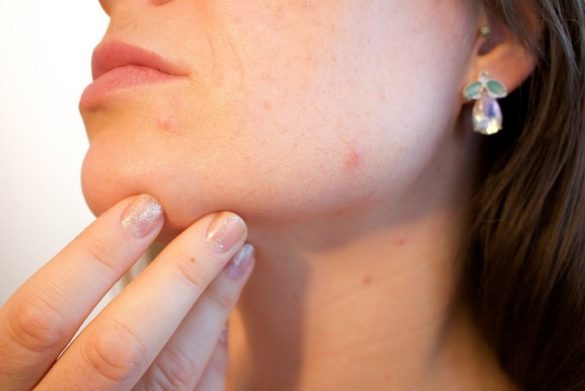 blackheads