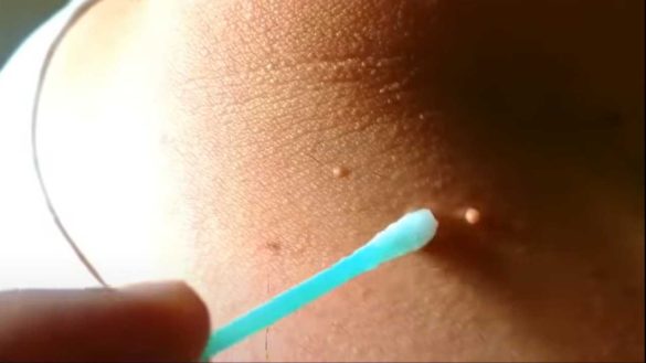 remove skin tag